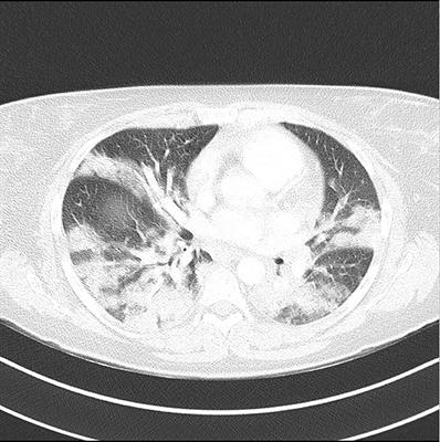 Case Report: Late-Onset Congenital Adrenal Hyperplasia and Acute Covid-19 Infection in a Pregnant Woman: Multidisciplinary Management